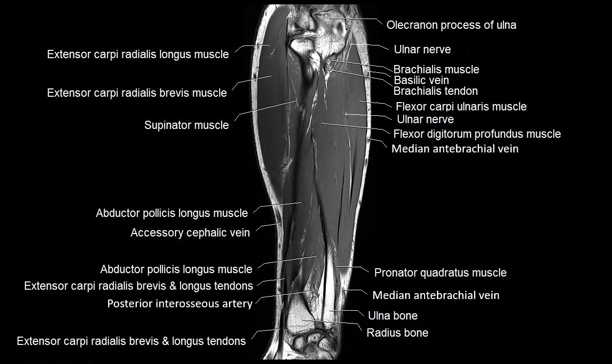 MRI 3T forearm coronal cross sectional anatomy image 18.webp